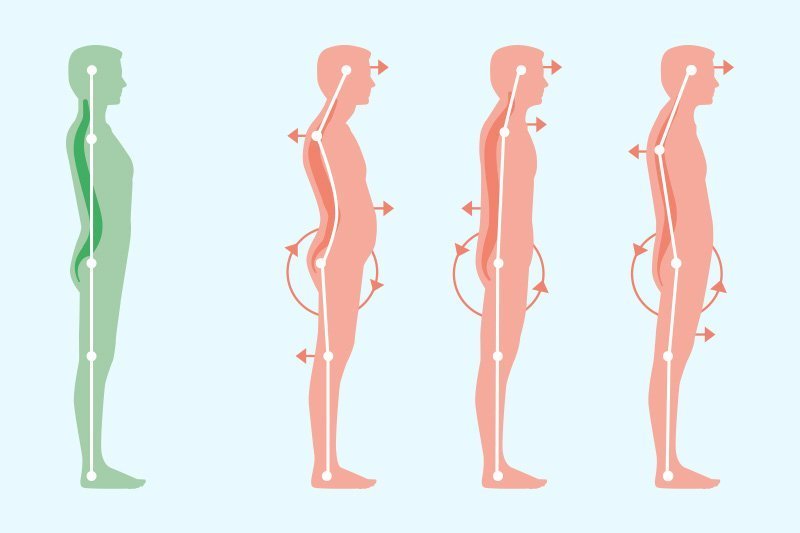 Take Our Posture Test How To Tell If You Have Bad Posture