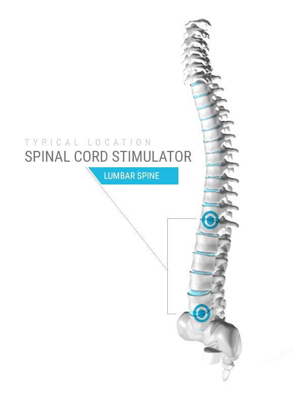 https://www.csiortho.com/images/content/spinal-cord-stimulator-cost.1910210920550.jpg